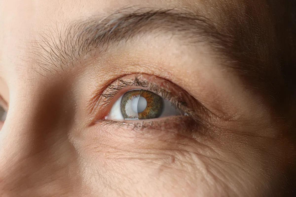 close-up of a woman's eye with a cataract